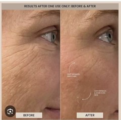 Evenskyn Lumo EvenSkyn Lumo Premium RF+ EMS EAnti-Aging & Skin Tightening 5 in 1