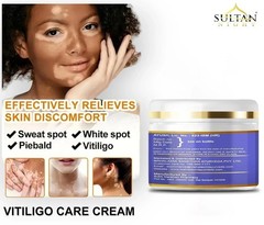 Vitiligo Cream 100gm Effective Herbal Formula For White Patches & Skin Repair