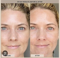Evenskyn Lumo EvenSkyn Lumo Premium RF+ EMS EAnti-Aging & Skin Tightening 5 in 1