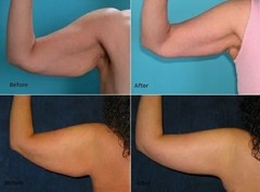 Flabby saggy arms double chin firming cream wrinkle remover cellulite reducer ☆