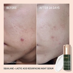 Squalane + 10% Lactic Acid Resurfacing Serum – Size: 30mL/1oz