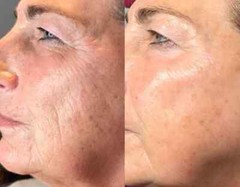 Argireline Matrixyl 3000 Hyaluronic Acid Peptide Serum Wrinkle Collagen Cream