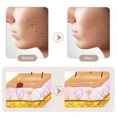 Anti-Aging Laser Plasma Pen-Wart Remover Mole Removal Dark Spot Skin Tag Tattoo