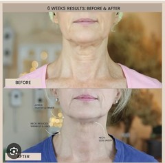 Evenskyn Lumo EvenSkyn Lumo Premium RF+ EMS EAnti-Aging & Skin Tightening 5 in 1