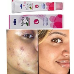 Hapdco Marks Go Cream 25g Help to remove blemishes, dark circles, and burn marks