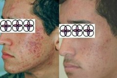 10-20-30-40-50-60-70% Glycolic Acid Night Cream 2oz/ 60ml Aging/Acne/scar