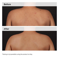 The Ordinary Salicylic Acid 0.5% Body Serum, Exfoliating Treatment for Acne-Pron