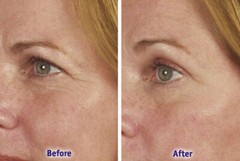 Argireline Matrixyl 3000 Hyaluronic Acid Peptide Serum Wrinkle Collagen Cream