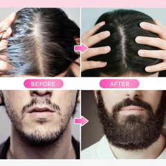 Derma Roller for Hair Loss Beard Growth 0.5-2.0mm Microneedle Dermaroller US
