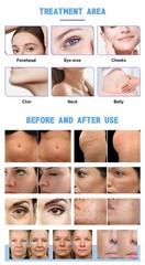 3 IN 1 Fractional Depth Gold RF M8 Ice Hammer Face Lift Anti-Aging Machine USA