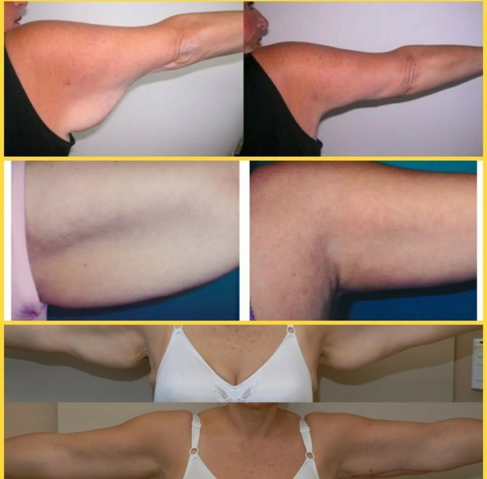 Flabby saggy arms double chin firming cream wrinkle remover cellulite reducer ☆