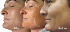 Resurfacing Chemical Peel 90% Acid Concentrated Formula MUST DILUTE Niacinamide