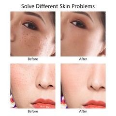 Laser Plasma Pen Wart Dark Spot Tattoo Mole Tag Removal Pen Skin Beauty Machine