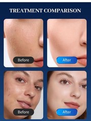 3 in 1 Wrinkles Firming Acne Scars Skin Tightening Facial Lifting Beauty Machine