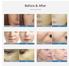 EMS Meso Injector No Needle Skin Wrinkle Removal Care Machine RF Mesotherapy Gun
