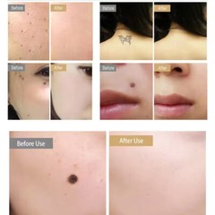 Anti-Aging Laser Plasma Pen-Wart Remover Mole Removal Dark Spot Skin Tag Tattoo