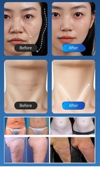 3 in 1 Wrinkles Firming Acne Scars Skin Tightening Facial Lifting Beauty Machine