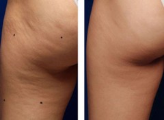 CELLULITE REMOVAL COMPLEX FOR FACIAL & BODY ~FIRM / FLAT / SMOOTH SKIN