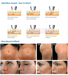 2in1 RF Micro-n-eedle Machine Cold Hammer Anti Scars Spot Wrinkle Removal Beauty