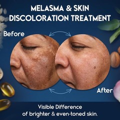 Dermatologist Recommended Melasma & Dark Spot Remover Cream for Radiant Skin