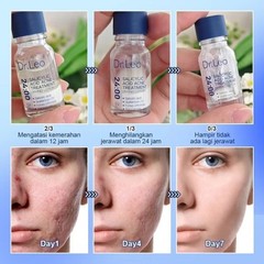 Dr. Leo Acne Essence – Salicylic Acid Serum for Acne & Scars NEW