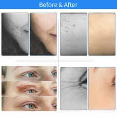 4TH Fibroblast Plasma Pen Needle Eyelid Lift Tightening Wrinkle Mole Remover