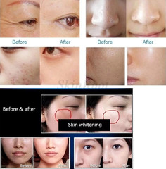 3-in-1 No-Needle Mesotherapy RF Skin Rejuvenation Facial Beauty Machine Salon