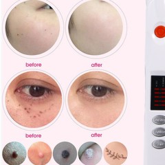 Laser Plasma Pen Electric Instrument To Remove Freckles Black Spots Skin Tags