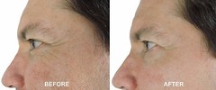 30% Glycolic Cell Renewal Peel Pads, Salicylic Acid, Lactic Acid, Argireline.