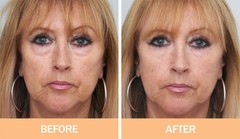 No.1 Instant Wrinkle Serum- 5 STAR REVIEWS- FOREHEAD/EYES MELB FAST SHIPPING