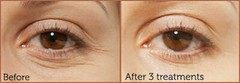 HYALURONIC ACID 100% Pure Anti Aging Hydrating Serum, Plumps Wrinkles Fine Lines