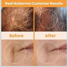 Pure Daily Care NuDerma Portable Handheld High Frequency Skin Therapy Wand