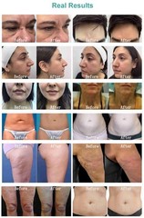 2026 New Professional Fractional M8 R-F Machine Skin Face Lift Skin Tightening