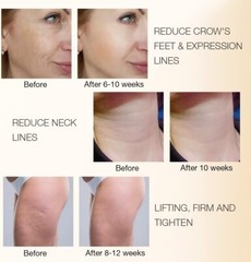 MLAY Facial Care Beauty Machine RF01 Skin Lifting Wrinkle Reducing Tightening US
